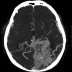 angio-TK tętnic mózgowych- naczyniak tętniczo- żylny